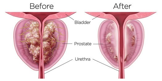 Rezum-Prostate-BPH-Before-After