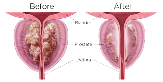 Rezum-Prostate-BPH-Before-After