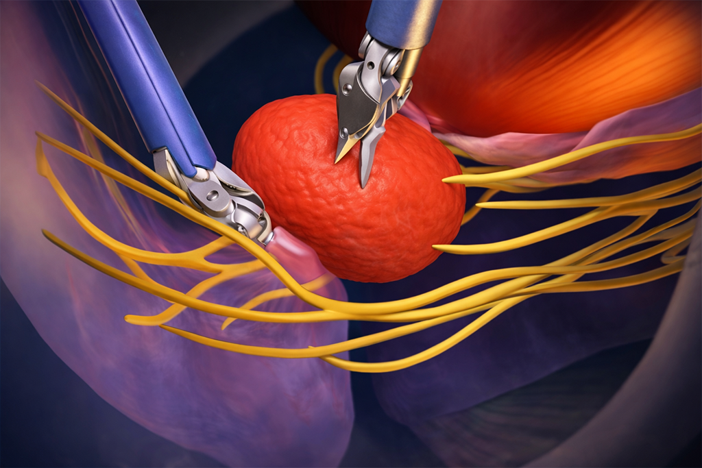 Robotic Surgery for Prostate Cancer